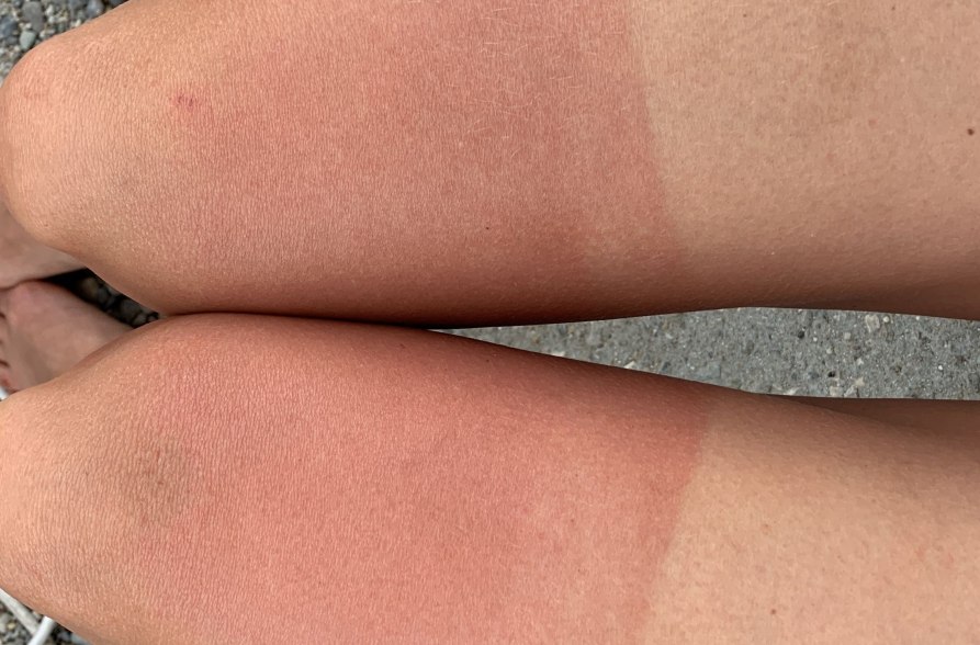Sonnenbrand nach Kajaktour, &copy; Inn-Salzach Tourismus